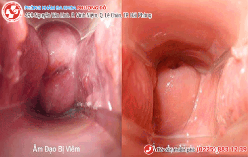 Viêm âm đạo khiến huyết trắng có mùi Viêm âm đạo khiến huyết trắng có mùi