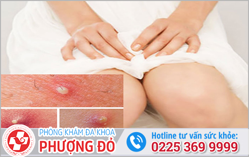 Mụn Nhọt Vùng Kín Gây Bệnh Phụ Khoa