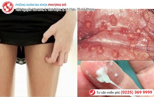 Ngứa âm đạo do nhiều nguyên nhân gây nên Ngứa âm đạo do nhiều nguyên nhân gây nên