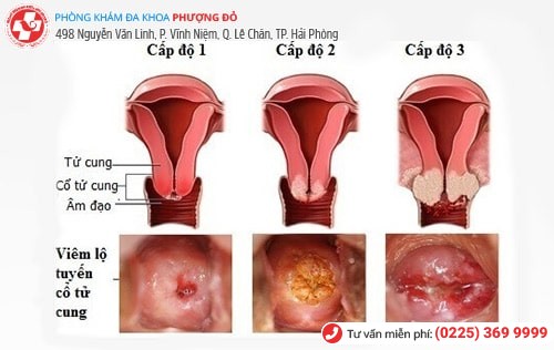 Ngứa âm đạo và cách điều trị phù hợp Ngứa âm đạo và cách điều trị phù hợp