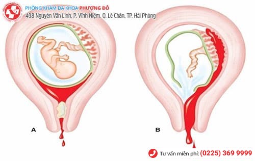 Nguy hiểm ra sao khi bị sót nhau thai? Nguy hiểm ra sao khi bị sót nhau thai?
