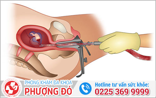 Phương pháp hút thai chân không dành cho thai trên 7 tuần tuổi