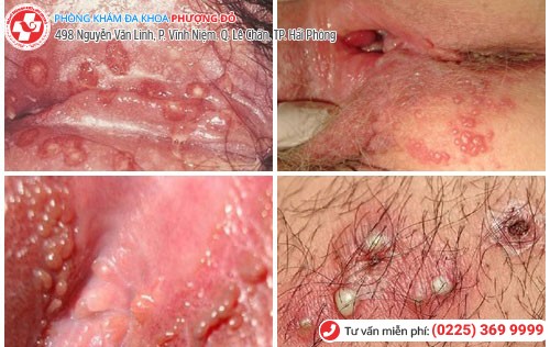 Phải làm gì sau khi quan hệ bị ngứa? Phải làm gì sau khi quan hệ bị ngứa?