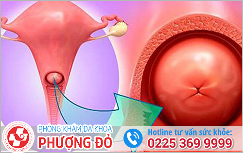 Phì Đại Cổ Tử Cung