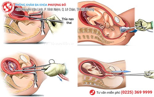 Phương pháp bỏ thai