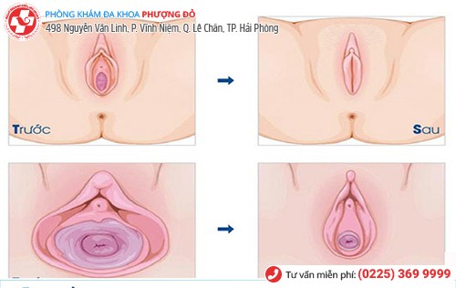 Kết quả sau khi thu hẹp âm đạo Kết quả sau khi thu hẹp âm đạo
