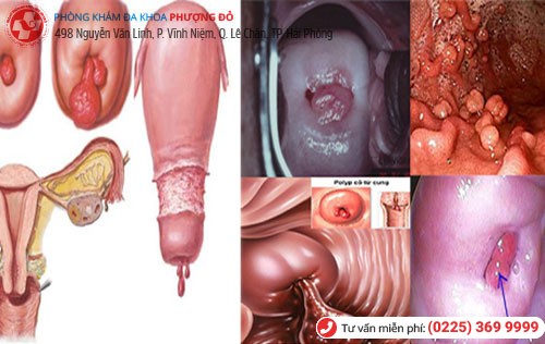 Hình ảnh khối Polyp cổ tử cung