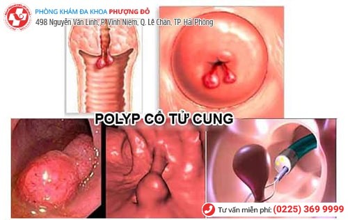 Polyp cổ tử cung khiến kinh nguyệt ra nhiều Polyp cổ tử cung khiến kinh nguyệt ra nhiều