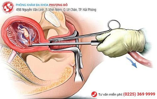 Quy trình hút thai ở Quảng Ninh được bác sĩ Phượng Đỏ thực hiện an toàn, hiệu quả