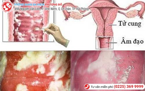 Chị em bị sưng vùng kín là dấu hiệu của bệnh gì? Chị em bị sưng vùng kín là dấu hiệu của bệnh gì?