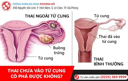 Thai chưa vào tử cung có phá được không? Giải đáp chi tiết từ bác sĩ chuyên khoa