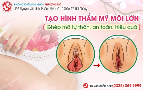 Thẩm mỹ vùng kín: Nên hay không? Thẩm mỹ vùng kín: Nên hay không?