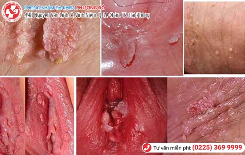Thịt dư âm đạo - dấu hiệu bệnh sùi mào gà Thịt dư âm đạo - dấu hiệu bệnh sùi mào gà