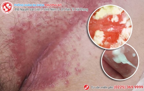 Nấm vùng kín là gì? Thuốc trị nấm được bác sĩ khuyên dùng Nấm vùng kín là gì? Thuốc trị nấm được bác sĩ khuyên dùng