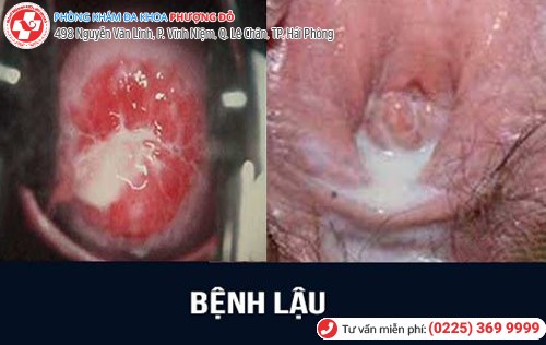 Tiểu ra máu ở phụ nữ là bệnh gì? Tiểu ra máu ở phụ nữ là bệnh gì?