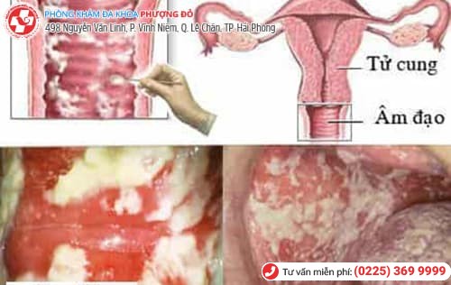triêu chứng nấm phụ khoa