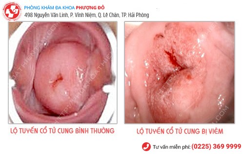 viêm lộ tuyến tử cung