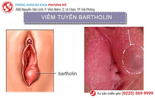 dấu hiệu viêm tuyến bartholin