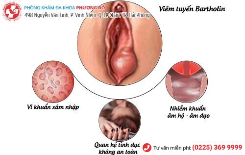 U cục sưng cứng gần âm đạo – Triệu chứng của viêm tuyến Bartholin U cục sưng cứng gần âm đạo – Triệu chứng của viêm tuyến Bartholin