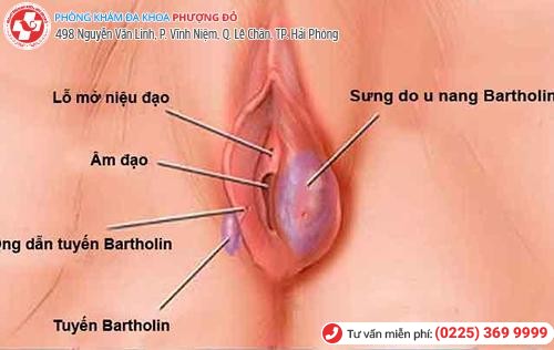 U cục sưng cứng gần âm đạo – Triệu chứng của viêm tuyến Bartholin U cục sưng cứng gần âm đạo – Triệu chứng của viêm tuyến Bartholin