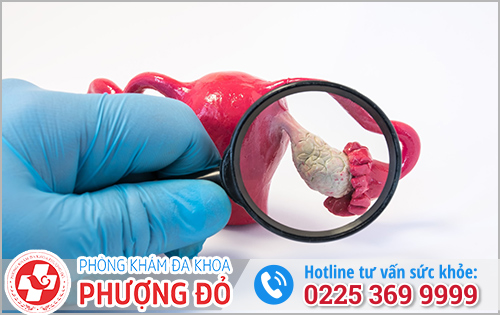 U Nang Buồng Trứng Là Bệnh Gì?