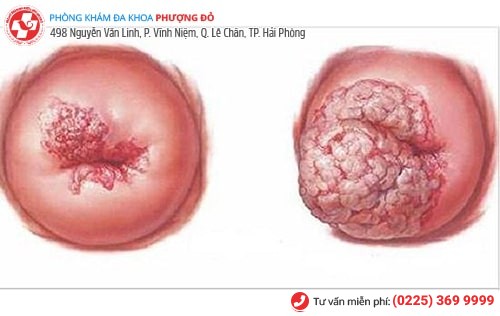 Nguy cơ ung thư cổ tử cung do viêm lộ tuyến Nguy cơ ung thư cổ tử cung do viêm lộ tuyến