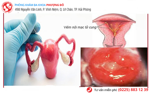 viêm nội mạc tử cung