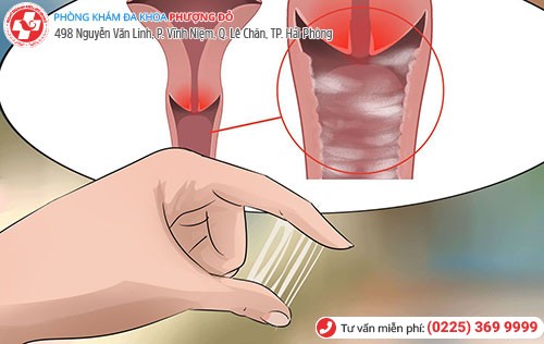 Âm đạo ra nước - dấu hiệu bệnh viêm âm đạo