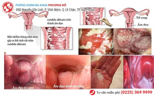 Viêm âm đạo khiến chị em bị ra máu khi quan hệ Viêm âm đạo khiến chị em bị ra máu khi quan hệ