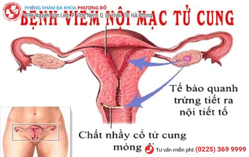 viêm nội mạc tử cung