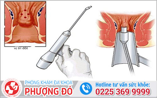 Các Phương Pháp Điều Trị Trĩ Khác