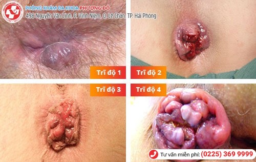 Các cấp độ bệnh trĩ Các cấp độ bệnh trĩ