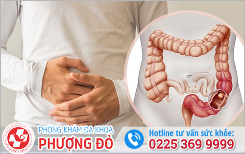 Polyp Trực Tràng Là Gì?