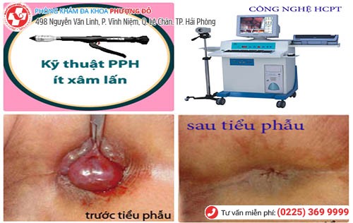 Kỹ thuật PPH