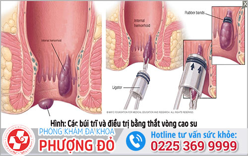 Những phương pháp chữa trĩ ngoài thuốc