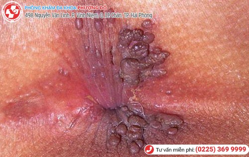 Hình 5 Nổi thịt thừa ở hậu môn 5