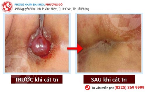 Tôi đã “đánh bại” bệnh trĩ nội như thế nào? Tôi đã “đánh bại” bệnh trĩ nội như thế nào?