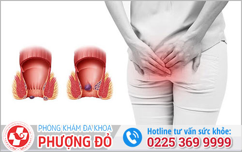 Bệnh Trĩ Và Những Biến Chứng Nguy Hiểm