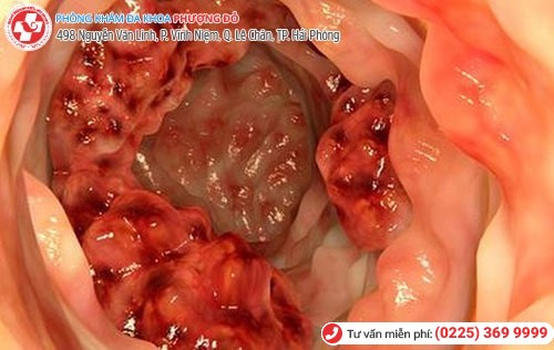 Ung thư đại trực tràng do biến chứng của trĩ Ung thư đại trực tràng do biến chứng của trĩ