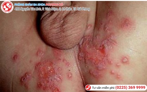 biểu hiện herpes sinh dục