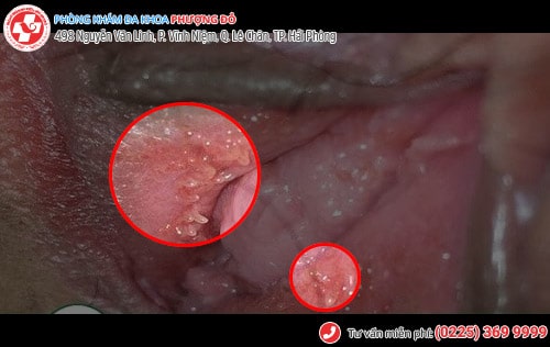 Chi tiết bệnh sùi mào gà ở nữ giai đoạn đầu Chi tiết bệnh sùi mào gà ở nữ giai đoạn đầu