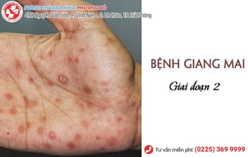 bệnh giang mai giai đoạn 2 bệnh giang mai giai đoạn 2