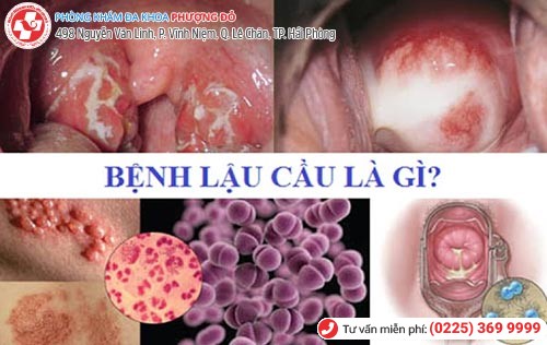Lậu do song cầu khuẩn lậu Neisseria gonorrhoeae gây nên