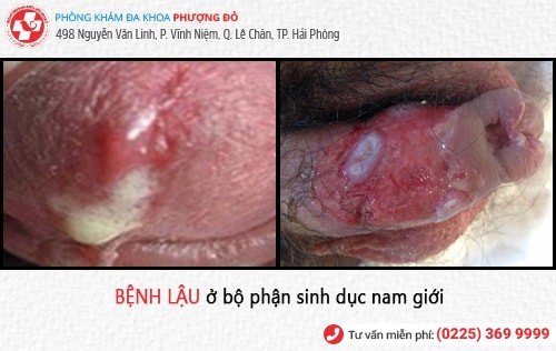 dấu hiệu bệnh lậu dấu hiệu bệnh lậu