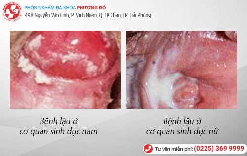 bệnh lậu bệnh lậu