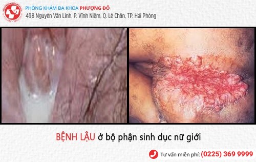 dấu hiệu bệnh lậu dấu hiệu bệnh lậu