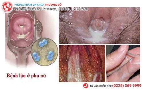 Lậu ở cơ quan sinh dục nữ Lậu ở cơ quan sinh dục nữ