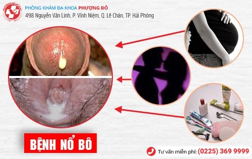 Bệnh nổ bô là gì? Phương pháp chữa bệnh nổ bô an toàn hiện nay Bệnh nổ bô là gì? Phương pháp chữa bệnh nổ bô an toàn hiện nay