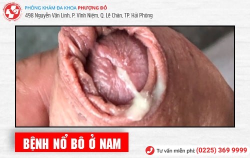 Bệnh nổ bô là gì? Phương pháp chữa bệnh nổ bô an toàn hiện nay Bệnh nổ bô là gì? Phương pháp chữa bệnh nổ bô an toàn hiện nay