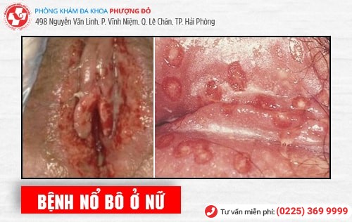 Bệnh nổ bô là gì? Phương pháp chữa bệnh nổ bô an toàn hiện nay Bệnh nổ bô là gì? Phương pháp chữa bệnh nổ bô an toàn hiện nay